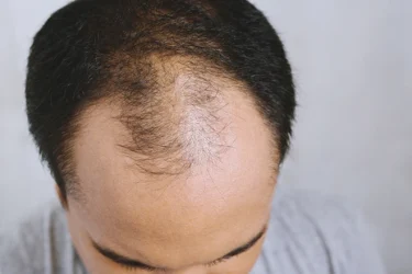 ベトナムのIT技術者は禿げやすい？